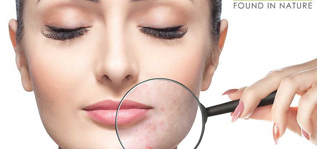 Hoe kan CBD acne helpen verminderen?